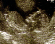 scan of baby at 13 weeks
